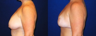 Left Profile View - Breast Lift After Pregnancy