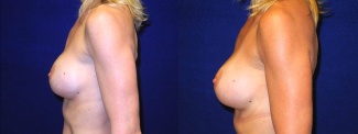 Left Profile View - Breast Implant Revision - Silicone Implants