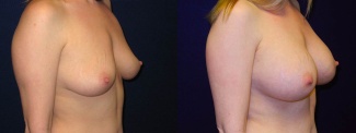 Right 3/4 View - Breast Augmentation - Silicone Implants