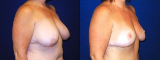 Right 3/4 View - Breast Lift After Pregnancy