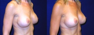 Right Profile View - Breast Implant Revision - Silicone Implants