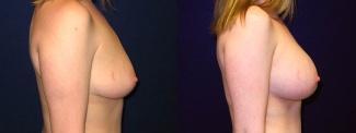 Right Profile View - Breast Augmentation - Silicone Implants