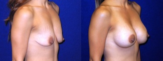 Right 3/4 View - Breast Augmentation with Lift After Pregnancy