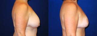 Right Profile View - Breast Lift After Pregnancy