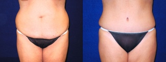 Frontal View - Tummy Tuck After Pregnancy