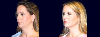 Left 3/4 View - Chin Liposuction