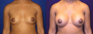 Frontal View - Breast Augmentation - Silicone Implants