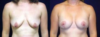 Frontal View - Breast Augmentation with Lift After Pregnancy