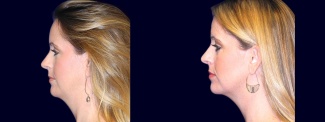 Left Profile View - Chin Liposuction