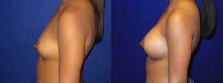 Left Profile View - Breast Augmentation - Silicone Implants