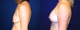 Left Profile View - Breast Augmentation with Lift After Pregnancy