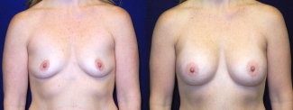 Frontal View - Breast Augmentation After Pregnancy