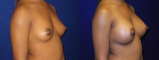 Right 3/4 View - Breast Augmentation - Silicone Implants