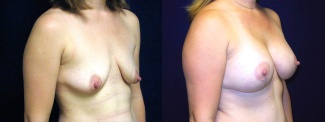 Right 3/4 View - Breast Augmentation with Lift After Pregnancy