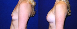 Left Profile View - Breast Augmentation After Pregnancy