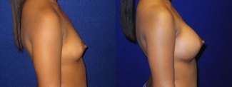 Right Profile View - Breast Augmentation - Silicone Implants