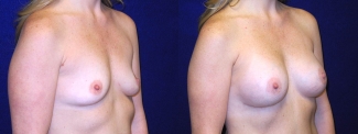 Right 3/4 View - Breast Augmentation After Pregnancy