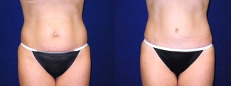 Frontal View - Tummy Tuck After Pregnancy