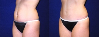 Left 3/4 View - Tummy Tuck After Pregnancy