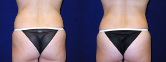 Posterior View - Tummy Tuck After Pregnancy