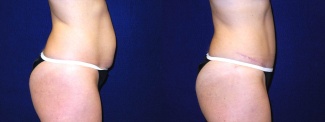 Right Profile View - Tummy Tuck After Pregnancy