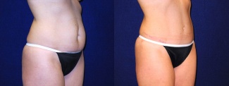 Right 3/4 View - Tummy Tuck After Pregnancy