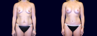 Frontal View - Breast Augmentation and Tummy Tuck After Pregnancy