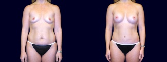 Frontal View - Breast Augmentation and Tummy Tuck After Pregnancy