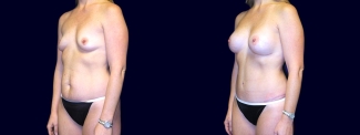 Left 3/4 View - Breast Augmentation and Tummy Tuck After Pregnancy