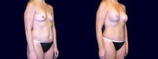 Right 3/4 View - Breast Augmentation and Tummy Tuck After Pregnancy