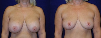 Frontal View - Breast Lift After Pregnancy