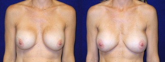 Frontal View - Breast Implant Revision - Silicone Implants