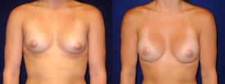 Frontal View - Breast Augmentation - Silicone Implants