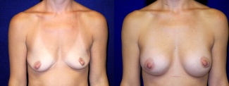 Frontal View - Breast Augmentation with periareolar Lift After Pregnancy with Silicone Implants