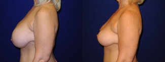 Left Profile View - Breast Lift After Pregnancy