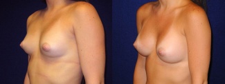 Left 3/4 View - Breast Augmentation - Silicone Implants