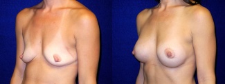 Left 3/4 View - Breast Augmentation with periareolar Lift After Pregnancy with Silicone Implants