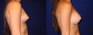 Right 3/4 View - Breast Augmentation - Silicone Implants