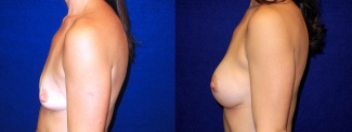 Left Profile View - Breast Augmentation with periareolar Lift After Pregnancy with Silicone Implants