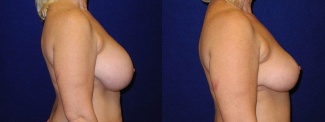 Right Profile View - Breast Lift After Pregnancy