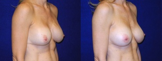 Right 3/4 View - Breast Implant Revision - Silicone Implants