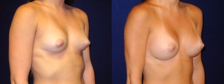 Right 3/4 View - Breast Augmentation - Silicone Implants