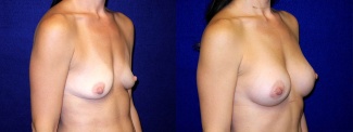 Right 3/4 View - Breast Augmentation with periareolar Lift After Pregnancy with Silicone Implants