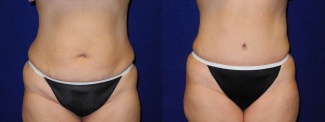 Frontal View - Tummy Tuck After Pregnancy