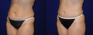 Left 3/4 View - Tummy Tuck After Pregnancy