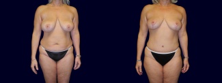 Frontal View - Breast Lift and Tummy Tuck After Pregnancy