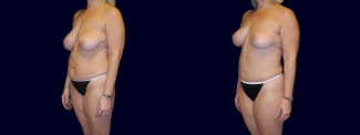 Left 3/4 View - Breast Lift and Tummy Tuck After Pregnancy