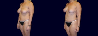 Left 3/4 View - Breast Lift and Tummy Tuck After Pregnancy