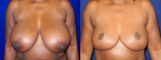 Frontal View - Breast Reduction After Pregnancy