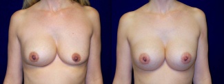 Frontal View - Breast Implant Revision - Silicone Implants